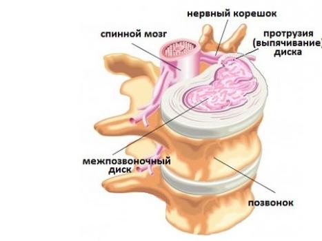Протрузия в грудном отделе позвоночника, ее признаки и лечение Грудная протрузия симптомы