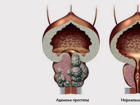 Находим простату для массажа в домашних условиях